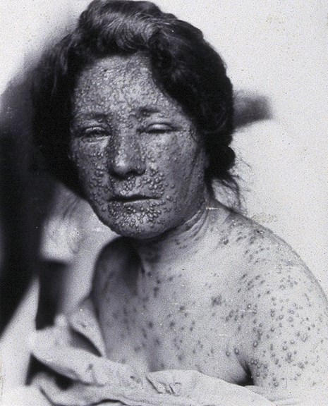A girl covered in sores