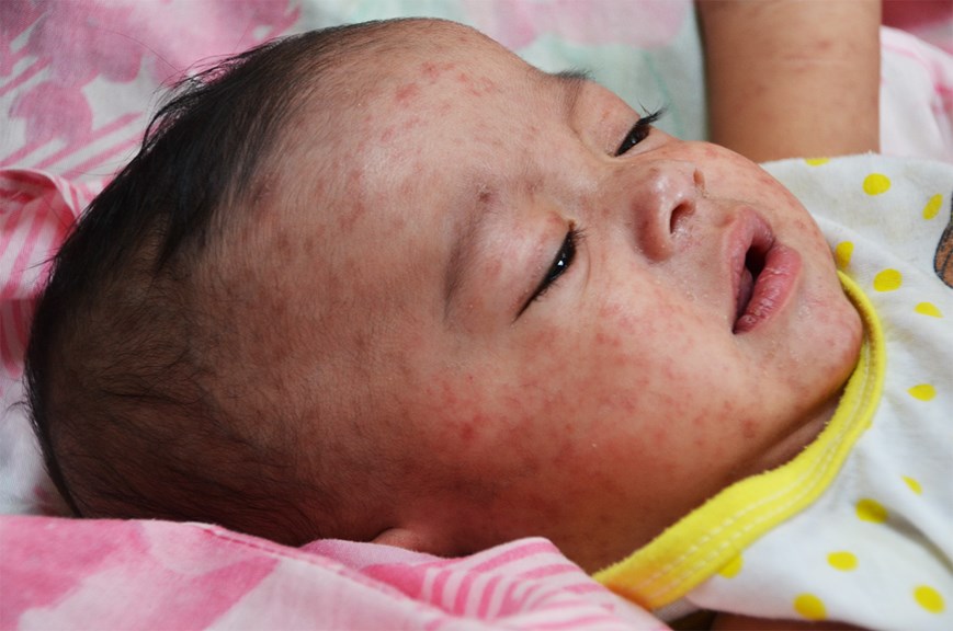 a baby's face covered in a red rash