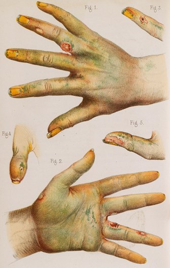 drawings of green stained hands with sores
